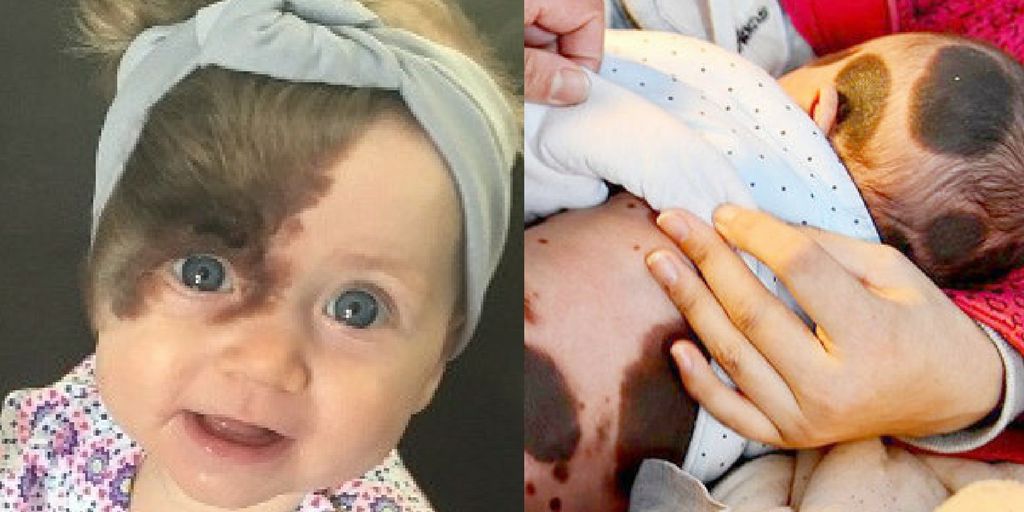 the-rarest-birthmarks-to-ever-appear-on-babies-babygaga