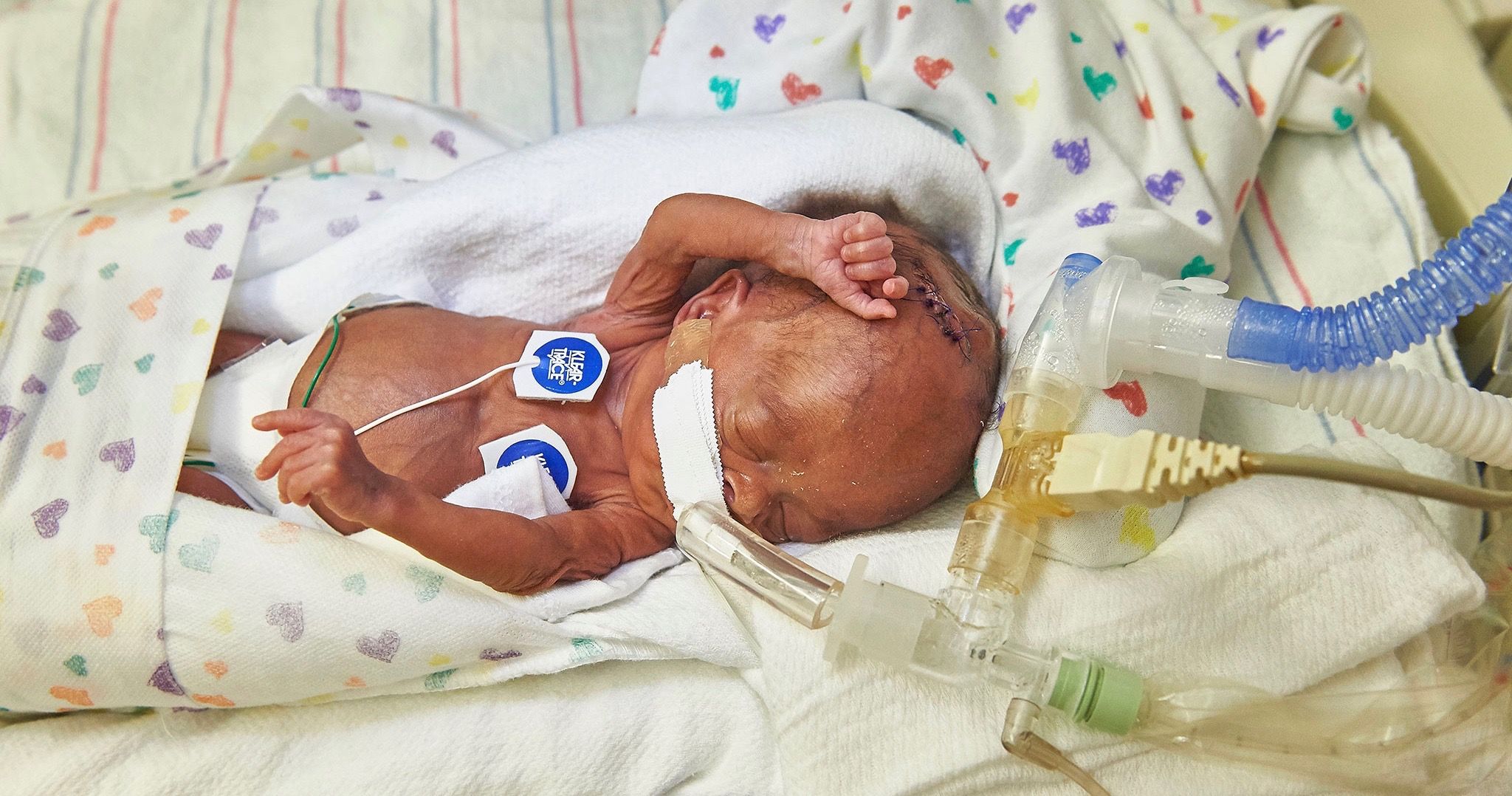 Stress & Plastic Additives During Third Trimester Increases Likelihood